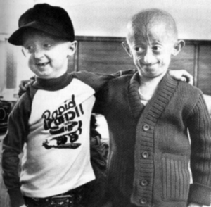 progeria-2.jpg